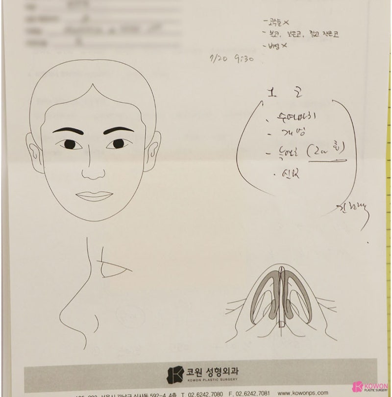 짧은코성형 남성 환자 코끝연장 통해 귀여운 이미지 탈출