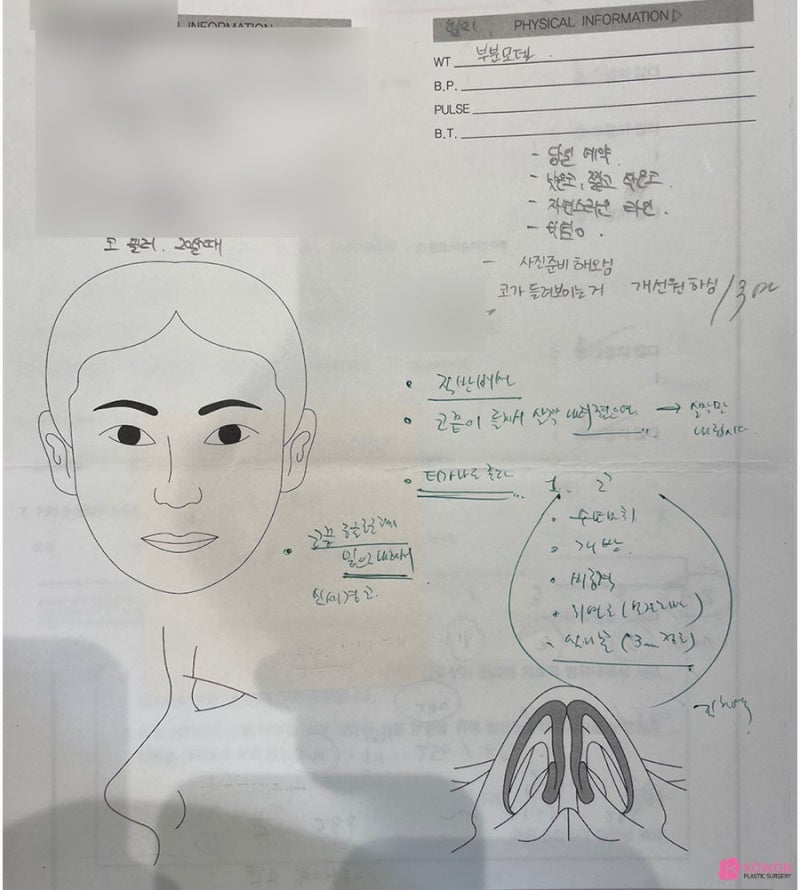 코필러부작용 해결 및 성공적인 콧대높이는수술 결과
