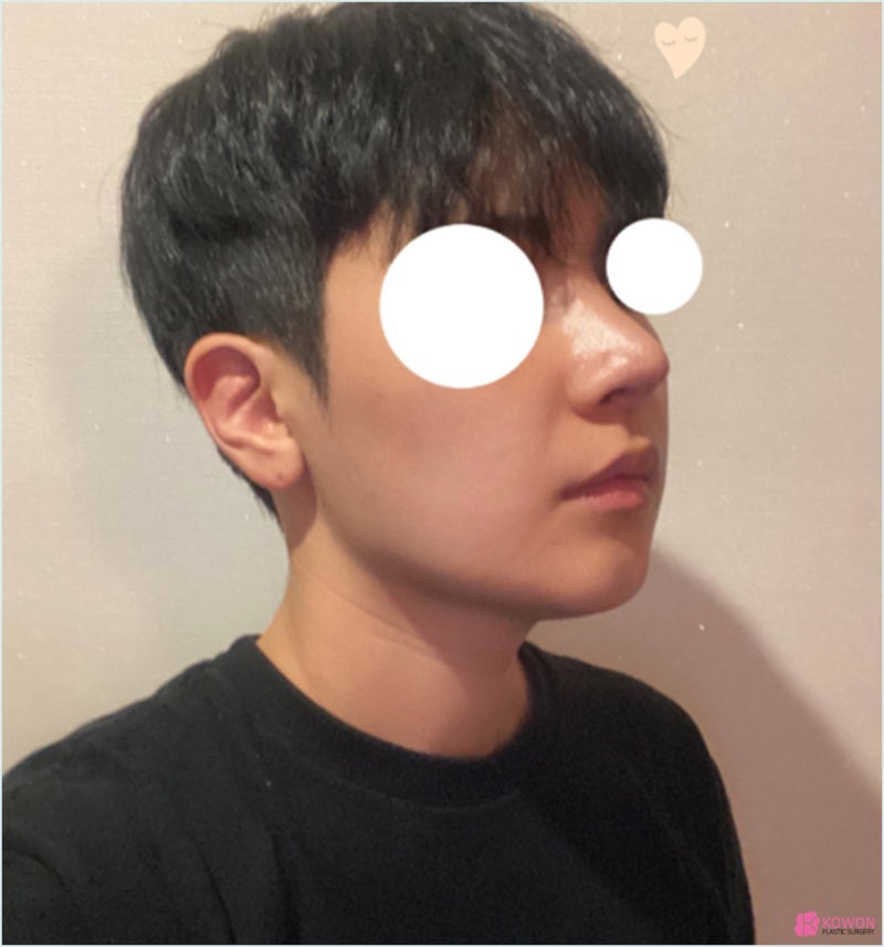 코재수술병원 코비대칭 콤플렉스 맞춤형 디자인 사진 10