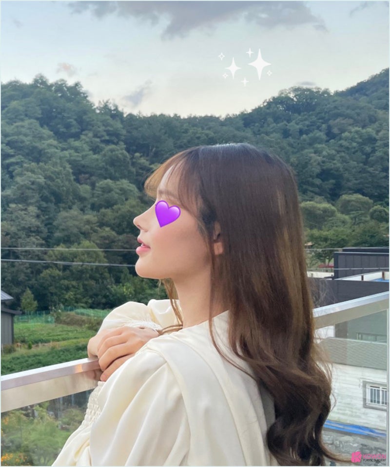 논현역성형외과 기증늑연골 수술 사례 콤플렉스 개선 사진 8
