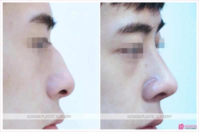 신사역성형외과 성공적인 매부리코수술후기 사진 3