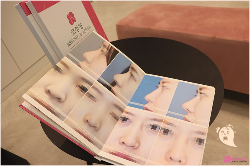 여자콧대 수술 화려한 이미지 변신 강남코성형잘하는곳