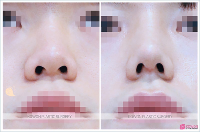 남자콧대수술 압구정로데오성형외과 이목구비 개선 사진 4