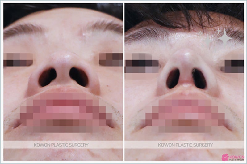 주먹코성형 압구정성형외과추천 세련된 이미지로 사진 4