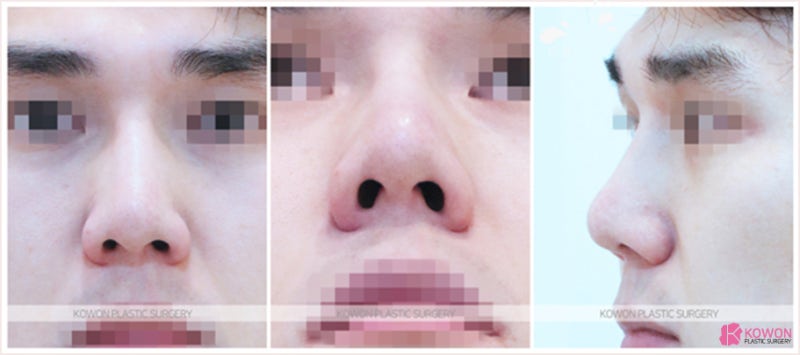 남자코재수술 낮은콧대 자연스럽게 높이는 방법