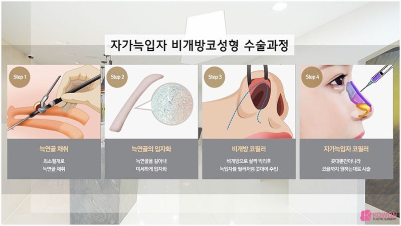 비개방코성형 수술 방법 대상 강남구성형외과 사진 4