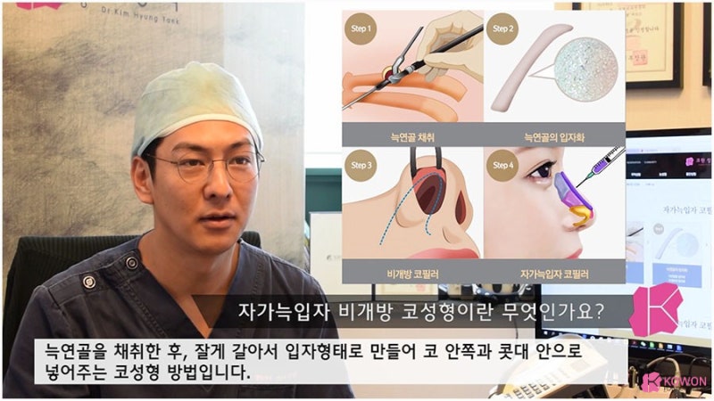 비개방코성형 수술 방법 대상 강남구성형외과 사진 3