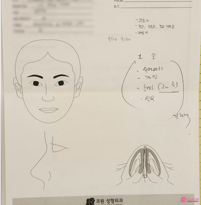 코끝연장술 방법 효과 코성형잘하는성형외과