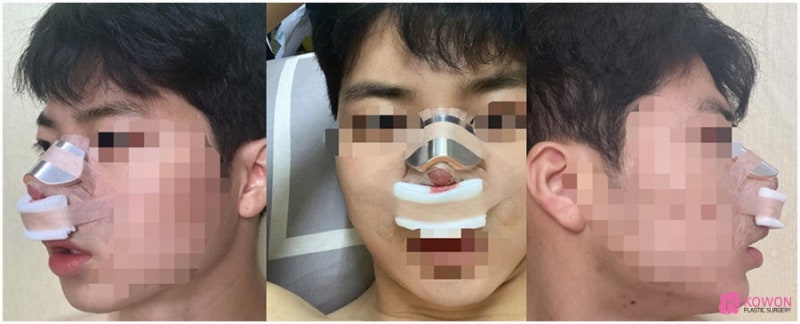 코끝연장술 방법 효과 코성형잘하는성형외과 사진 3
