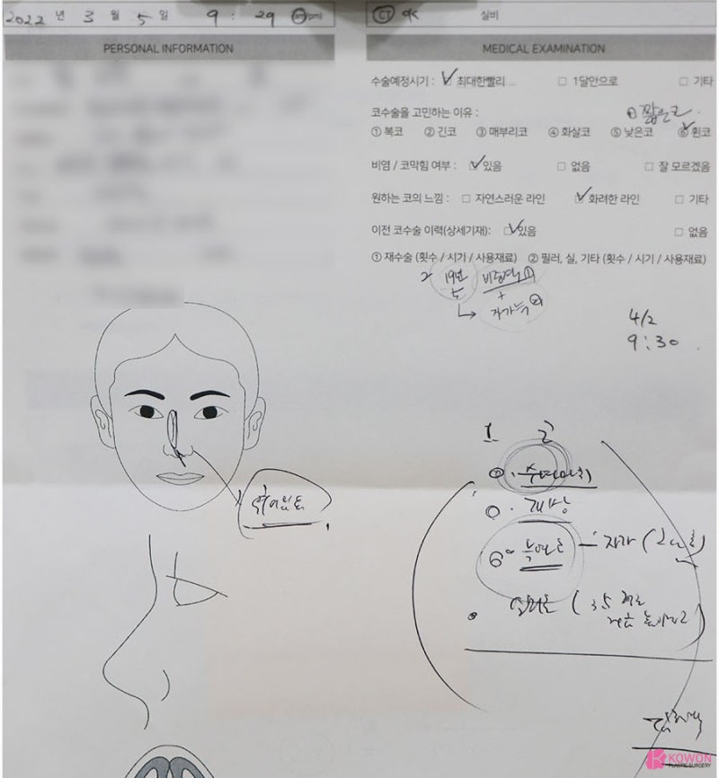 들창코성형 남성 환자 비교 코수술병원 소개
