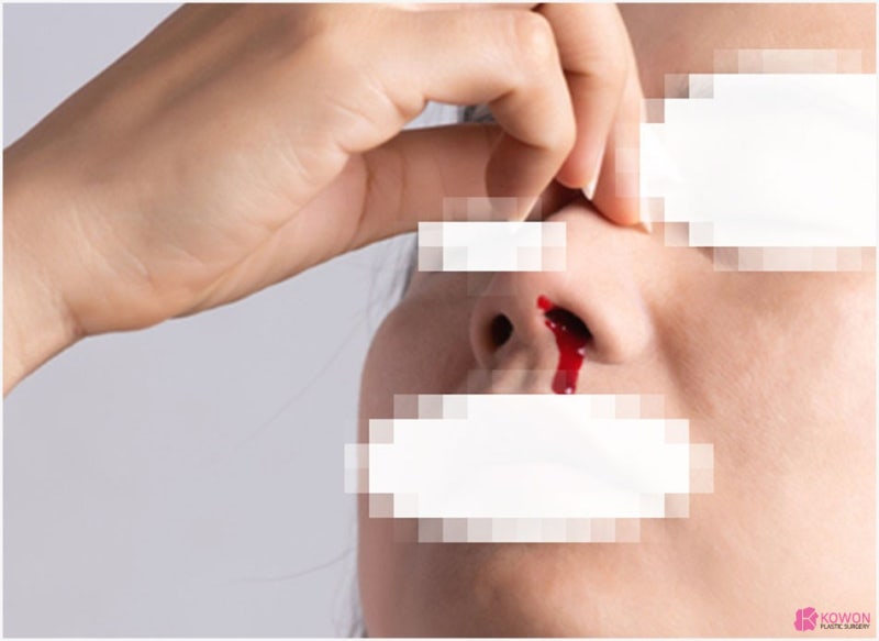 코피가안멈춰요 증상 호소한다면 대처 방법 사진 5