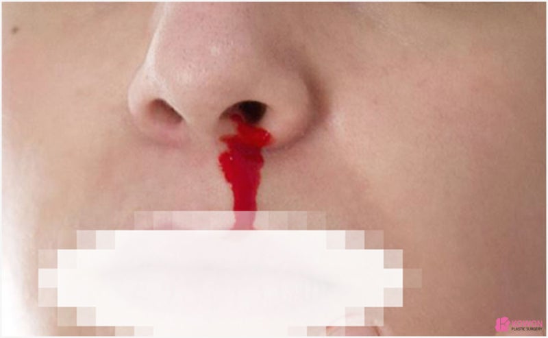 코피가안멈춰요 증상 호소한다면 대처 방법 사진 10