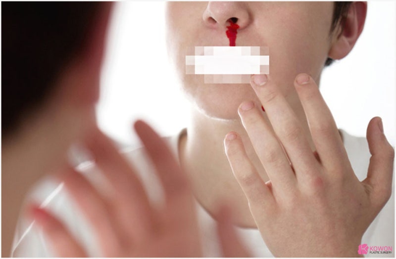 코피가안멈춰요 증상 호소한다면 대처 방법 사진 4