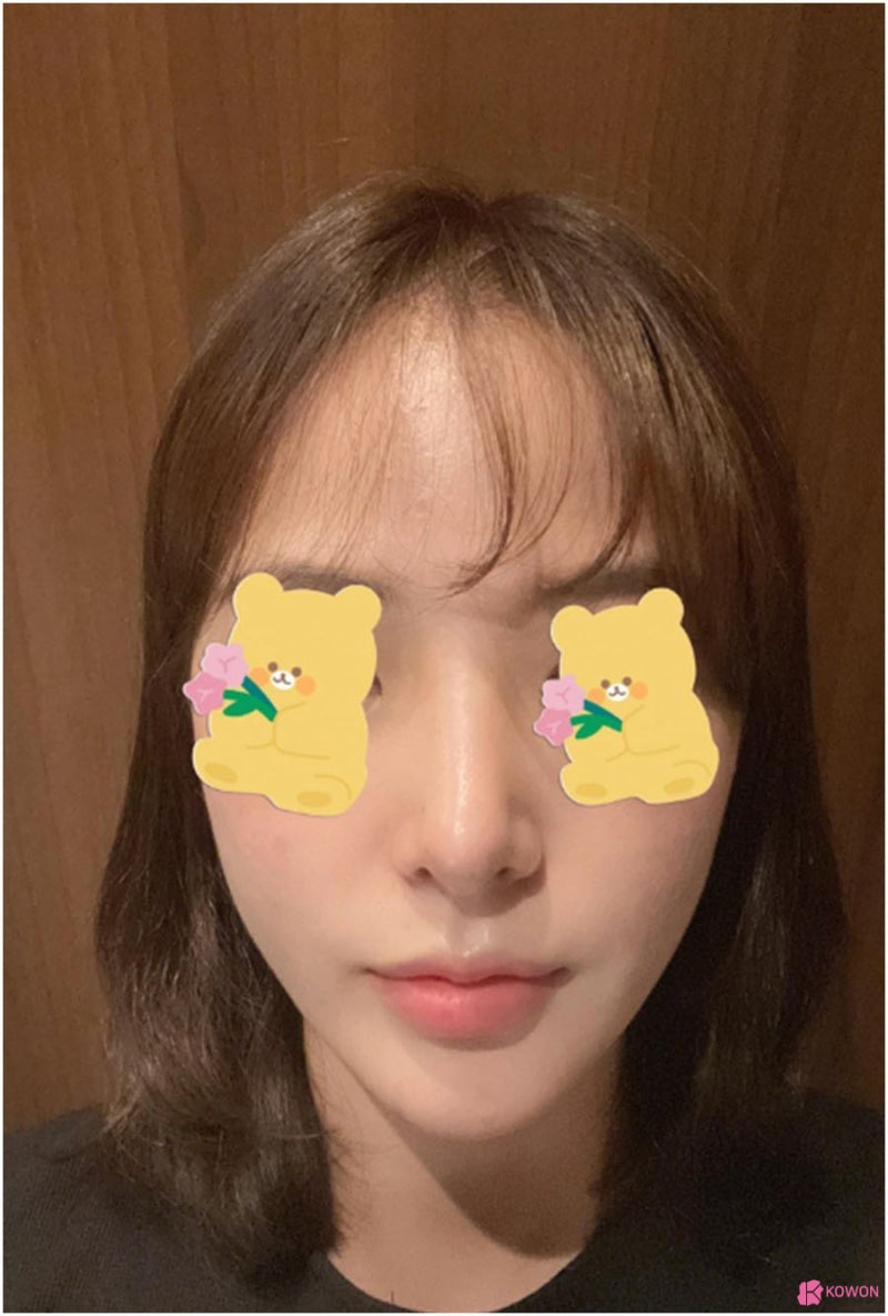 콧대높이기성형 통해 콤플렉스 개선 서울코재수술 사진 7