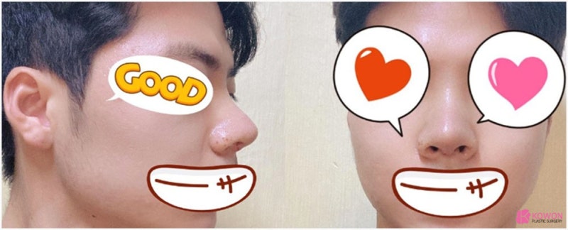 들린코성형 콤플렉스 개선 강남구청성형외과 사진 5