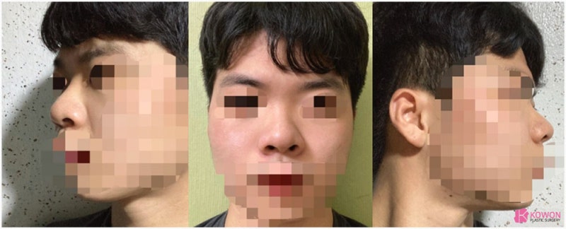 들린코성형 콤플렉스 개선 강남구청성형외과