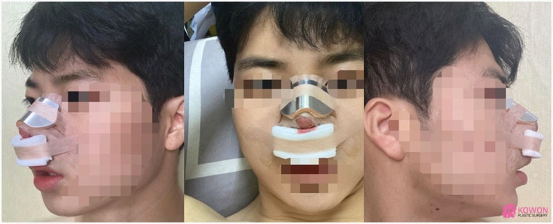 들린코성형 콤플렉스 개선 강남구청성형외과 사진 3
