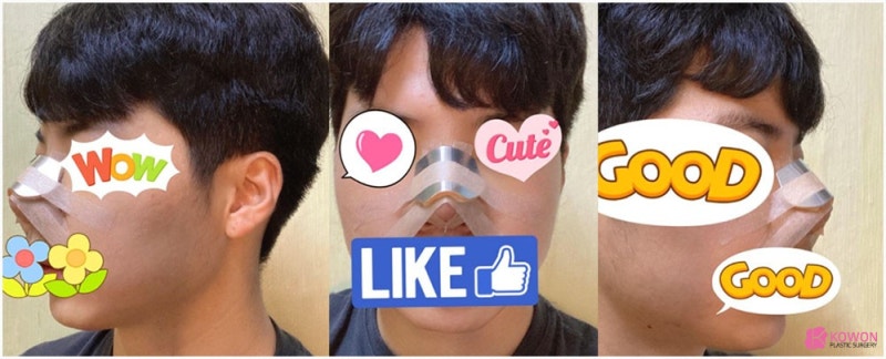 들린코성형 콤플렉스 개선 강남구청성형외과 사진 4