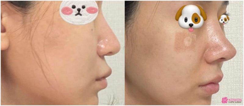 화살코수술 전후 비교 압구정역성형외과 사진 10