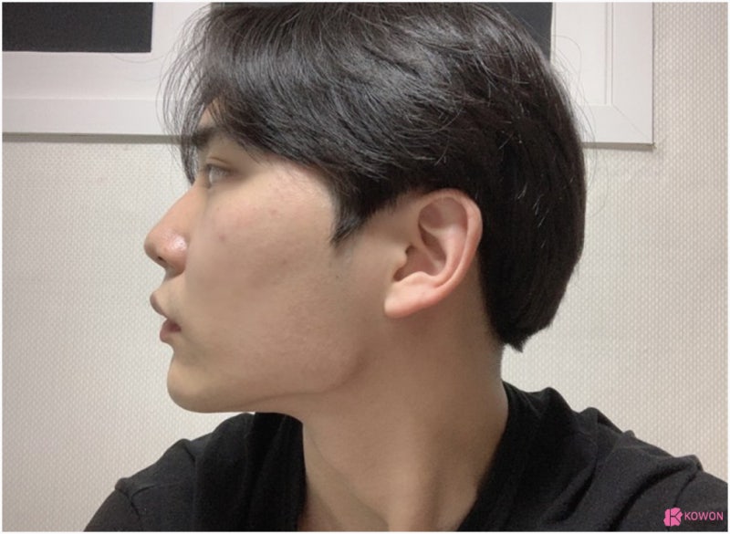 비염코성형수술 문제 개선한 압구정로데오성형외과 사진 3