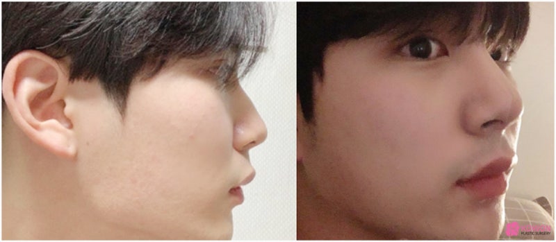 비염코성형수술 문제 개선한 압구정로데오성형외과