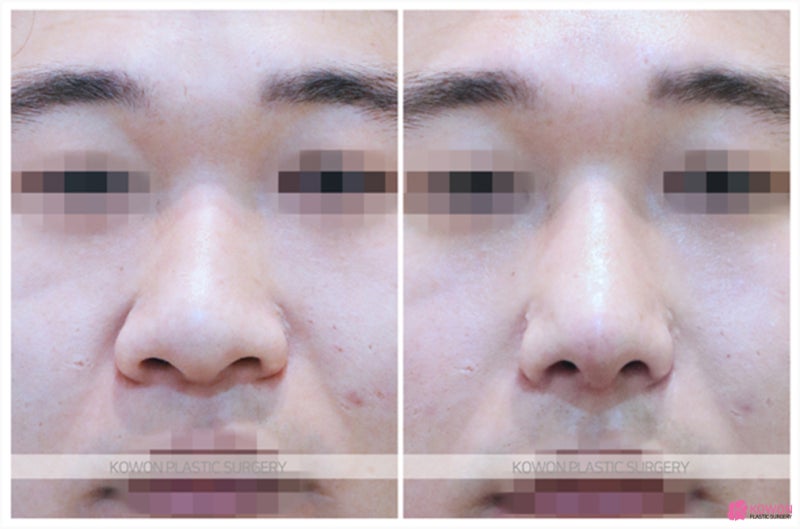 코끝성형후기 남성 환자 강남코수술 유명한 곳 사진 4