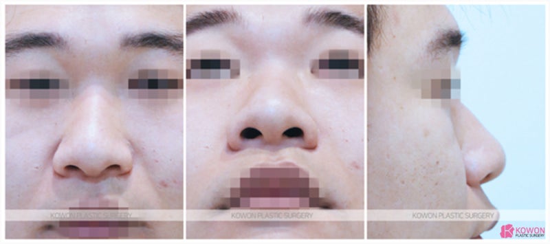 코끝성형후기 남성 환자 강남코수술 유명한 곳 사진 2