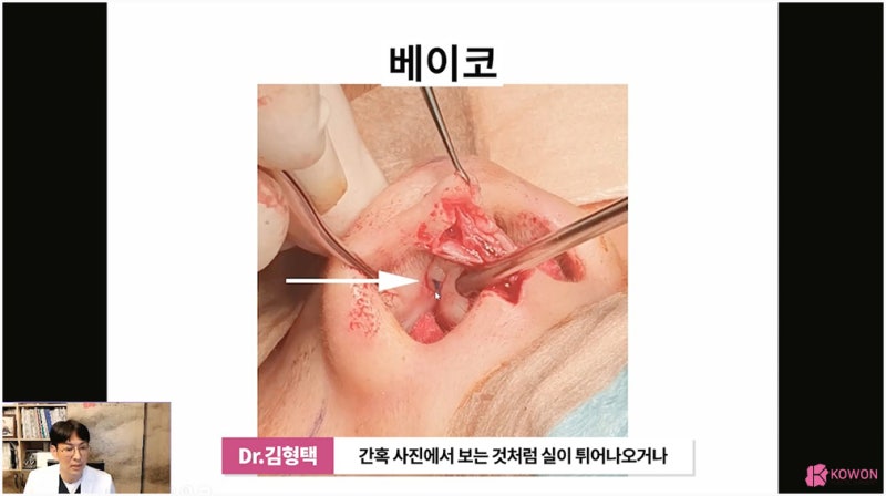 코실리프팅제거 방법 주의사항 서울코성형 사진 5