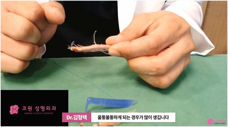 코실리프팅제거 방법 주의사항 서울코성형 사진 14