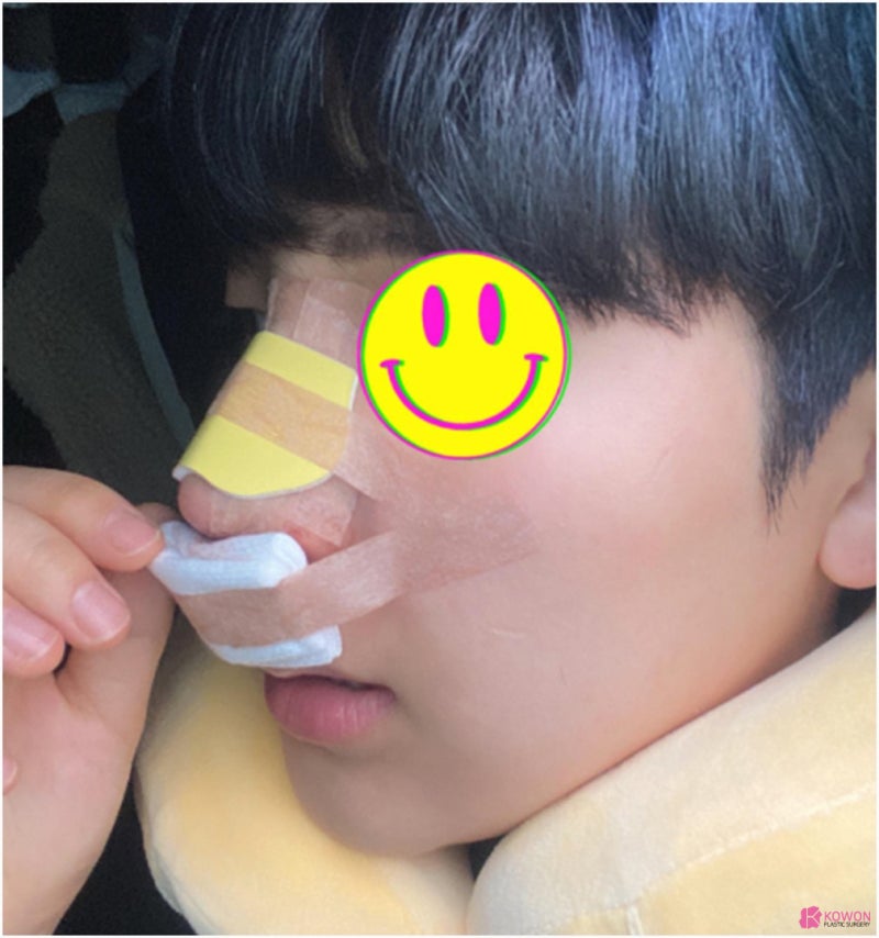 콧대높이기 사례 코재수술성형외과 찾는다면 사진 5
