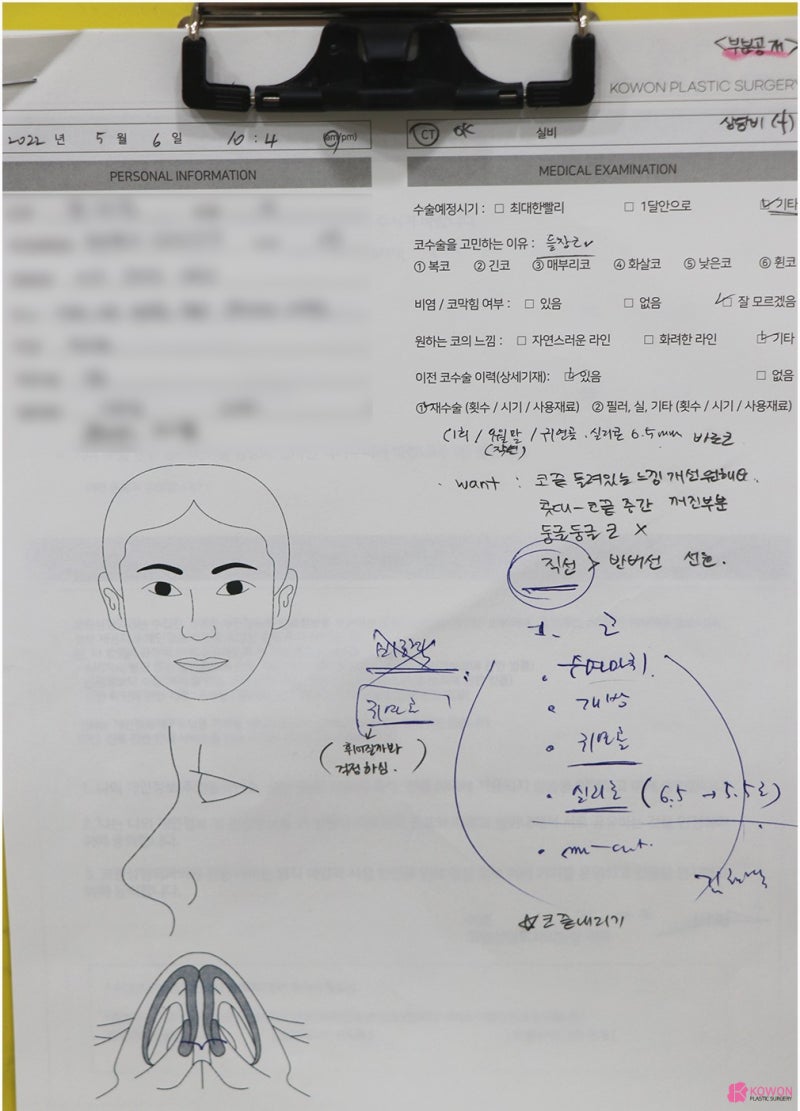 콧대높이기 사례 코재수술성형외과 찾는다면