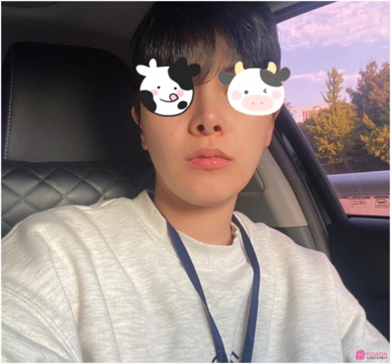 콧대높이기 사례 코재수술성형외과 찾는다면 사진 2