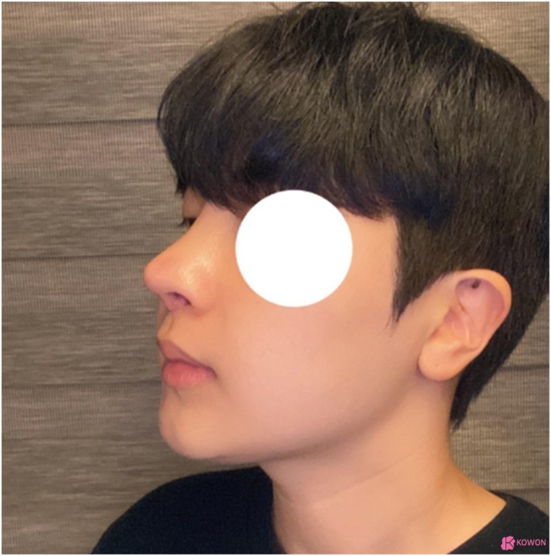 콧대높이기 사례 코재수술성형외과 찾는다면 사진 8
