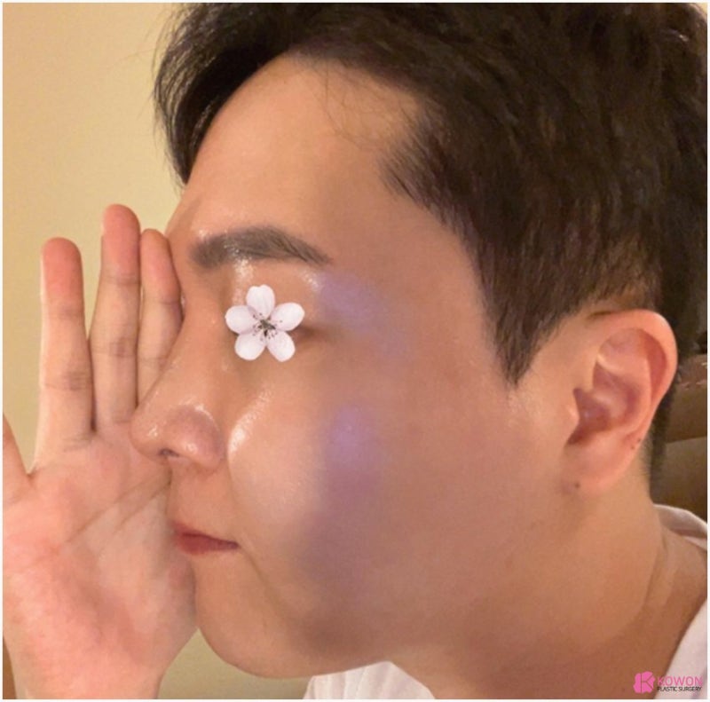 코성형후구축 나타났다면 코재수술병원 사진 8