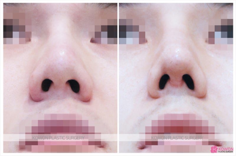 코재수술잘하는곳 남성 환자 미간성형 효과 사진 6