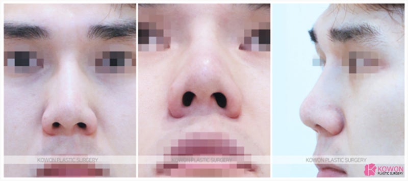 코재수술잘하는곳 남성 환자 미간성형 효과 사진 2