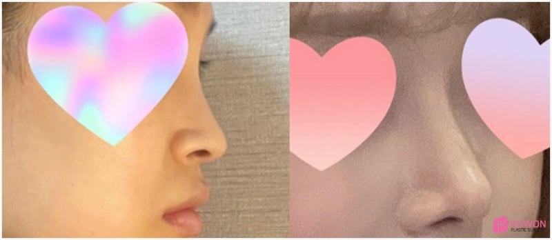 콧날개내리기 연예인 성형 여자코수술전후 사진 11