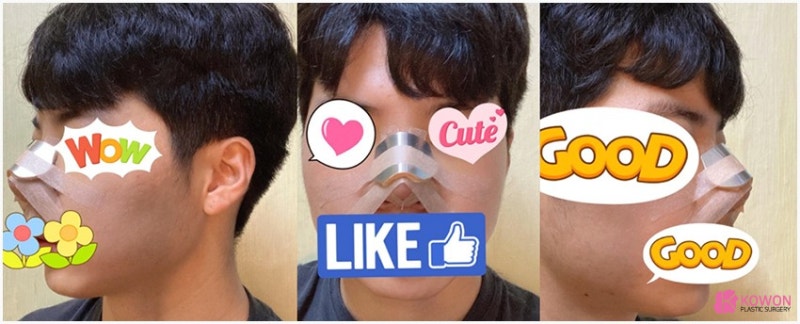 코끝각도 변화 코성형한달 후기 비교 사진 4