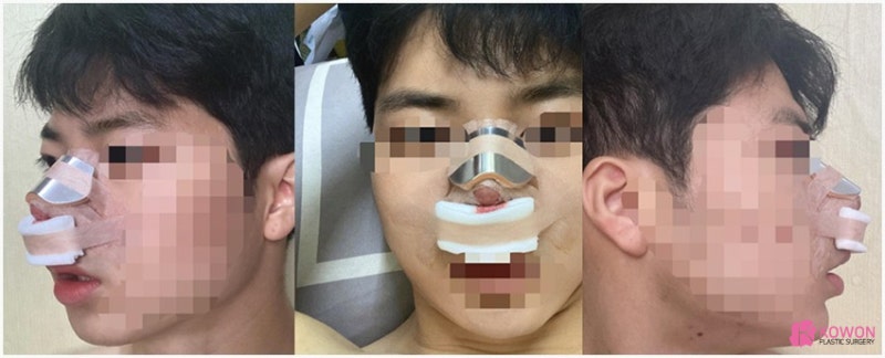 코끝각도 변화 코성형한달 후기 비교 사진 3