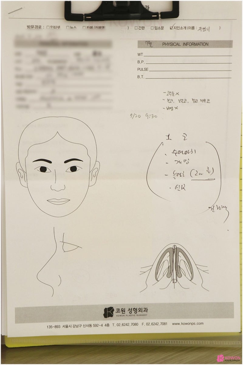 코끝각도 변화 코성형한달 후기 비교