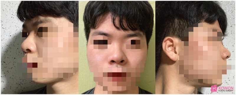 코끝각도 변화 코성형한달 후기 비교