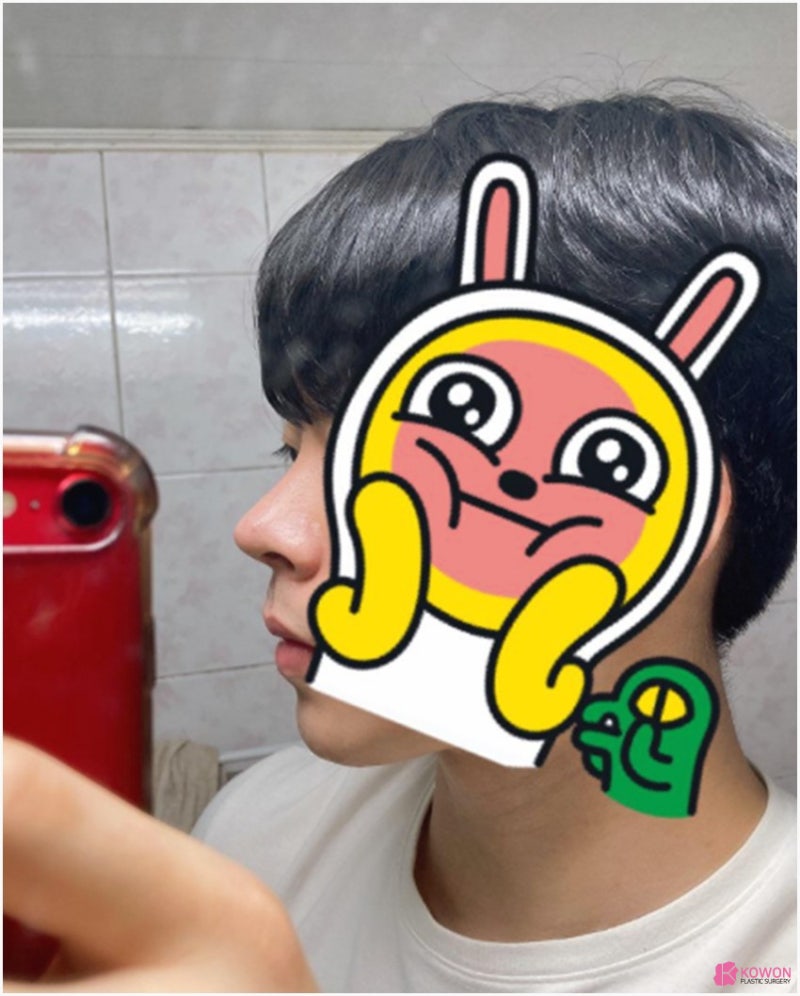 코끝각도 변화 코성형한달 후기 비교 사진 8