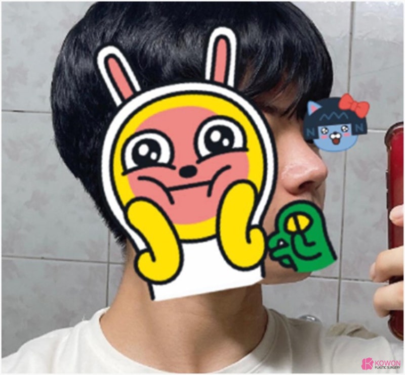 코끝각도 변화 코성형한달 후기 비교 사진 9