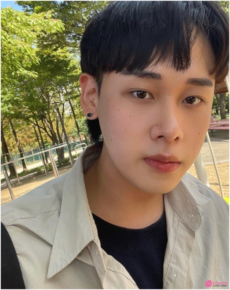 남자코성형전후 세련된코 수술 사례 사진 10
