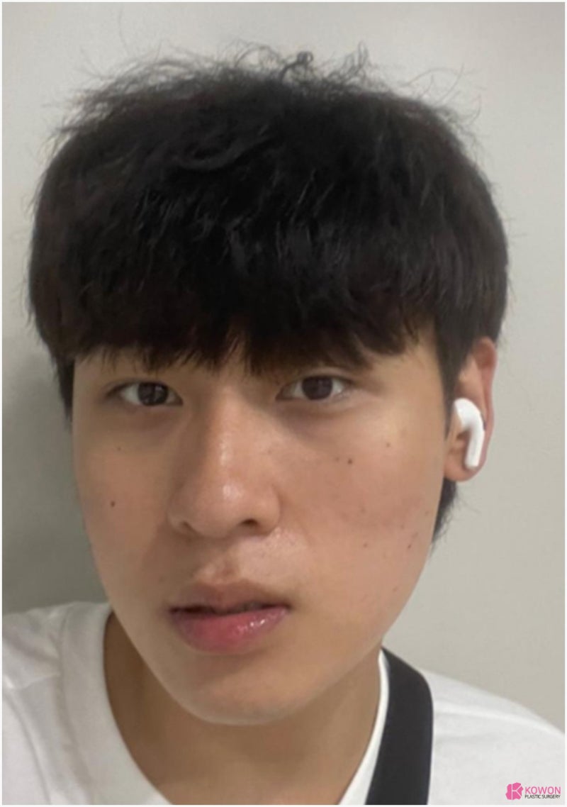 남자코성형전후 세련된코 수술 사례 사진 2