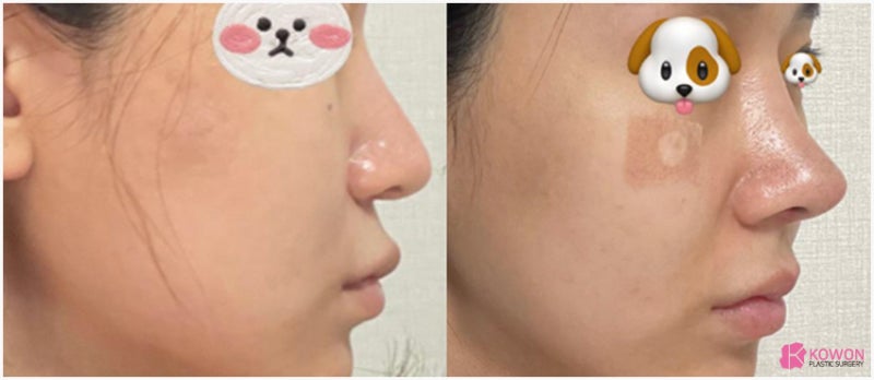 마녀코 처진 코 끝 개선 비순각수술후기 사진 10