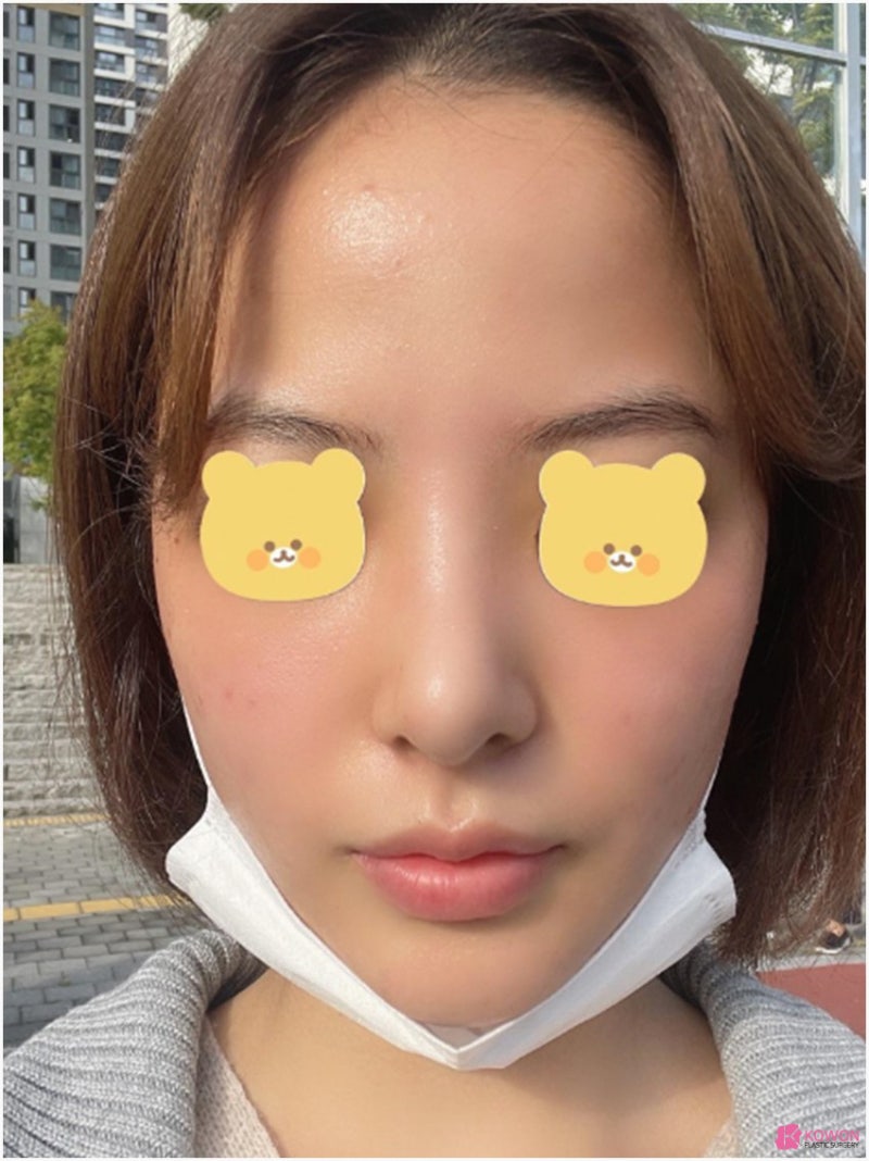 복코성형외과 콧대실리콘 이용한 방법 사진 10