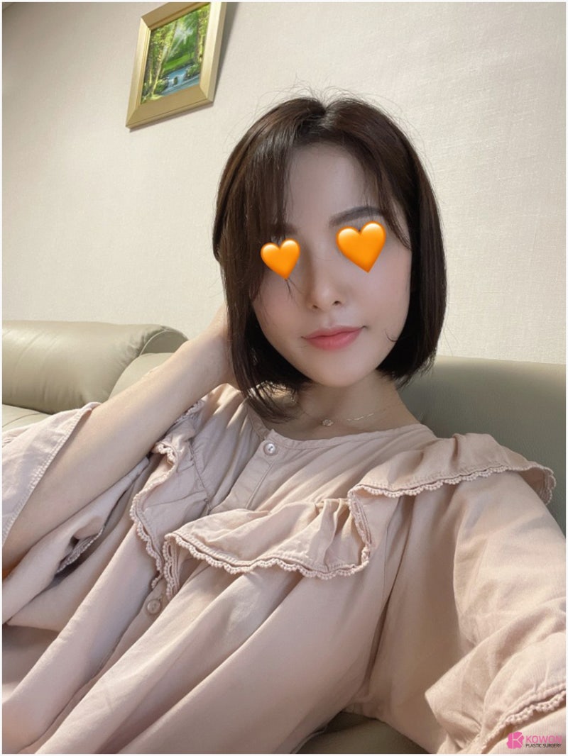 복코성형외과 콧대실리콘 이용한 방법 사진 12