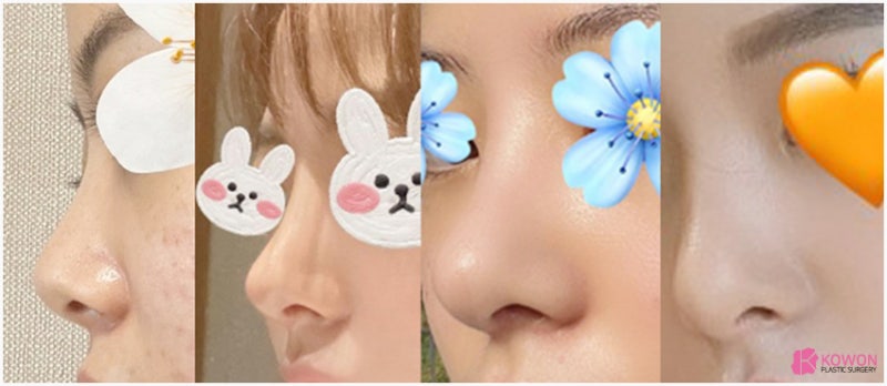 복코성형외과 콧대실리콘 이용한 방법
