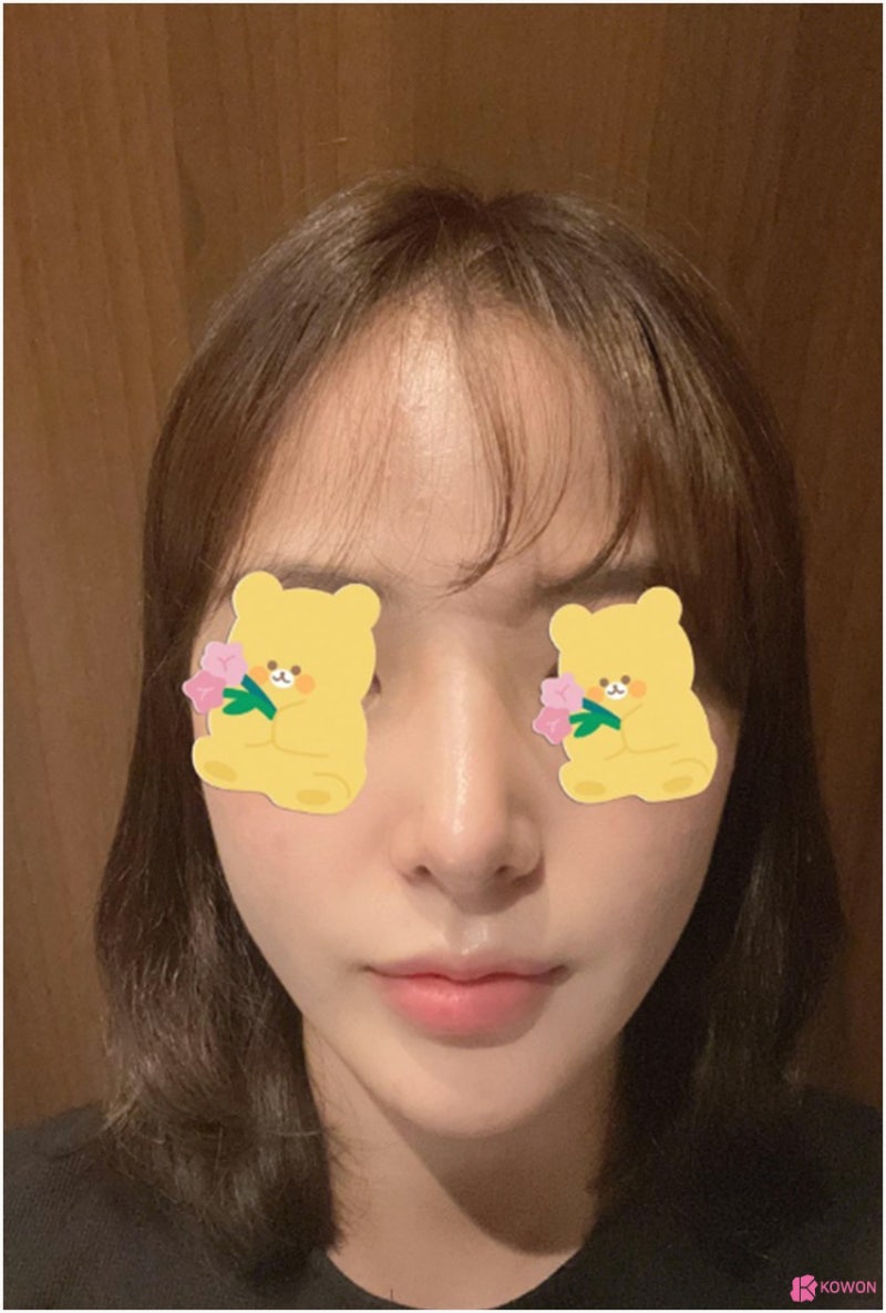 복코성형외과 콧대실리콘 이용한 방법 사진 7